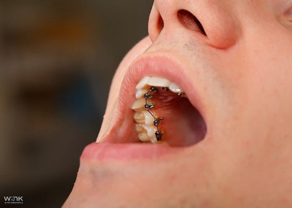 close up photo of lingual braces as one of the Alternatives to Braces in Prosper and Colleyville, TX.