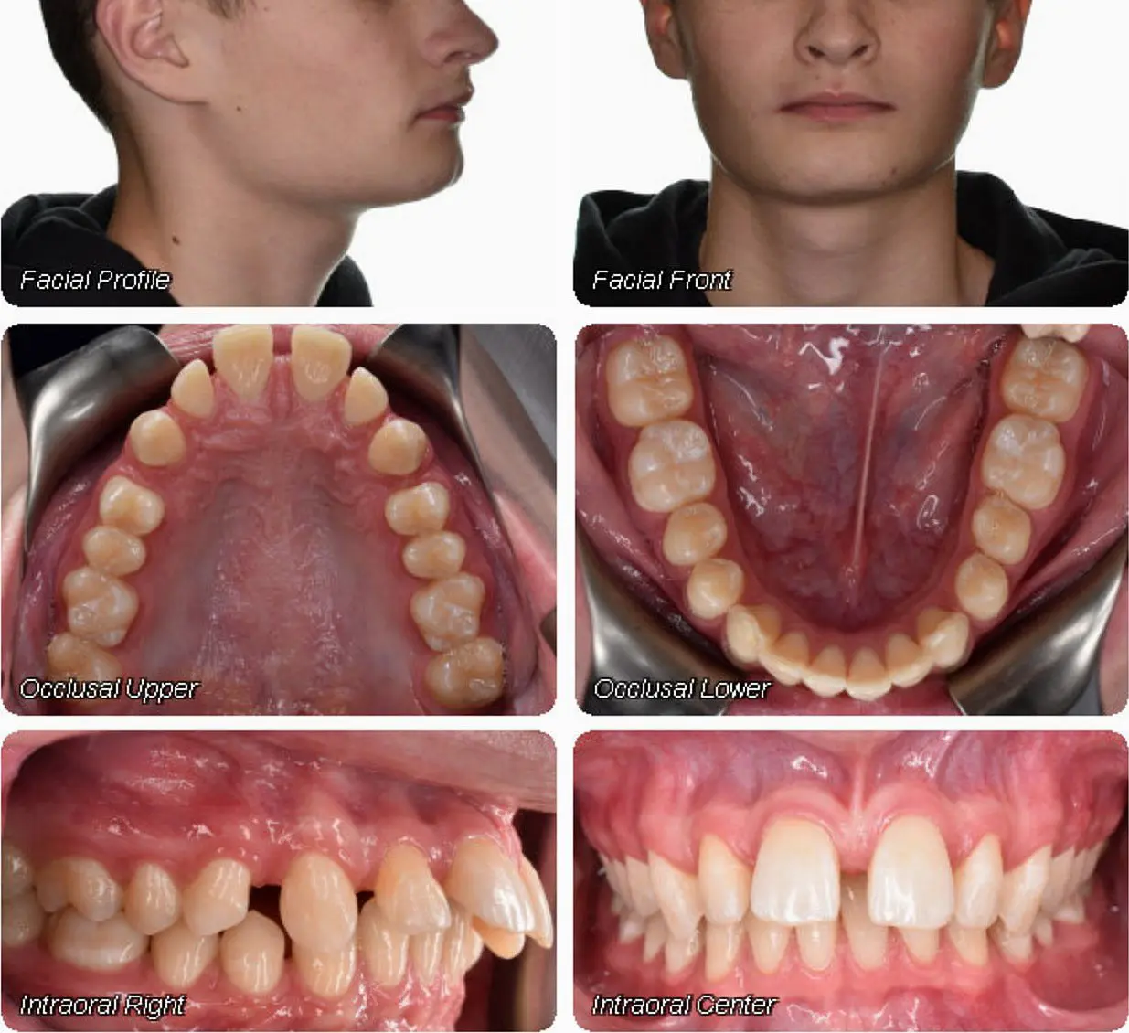 Six dental images at Wink Orthodontics Colleyville, TX show a person's facial profile, front view, upper and lower occlusal views, and intraoral right and center teeth alignment before braces.