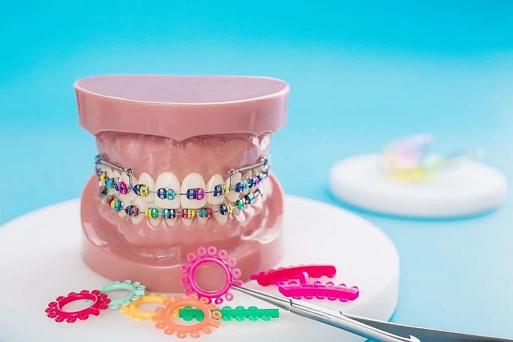 Colorful world of elastic ties of metal braces at Wink Orthodontics in Prosper or Colleyville, TX