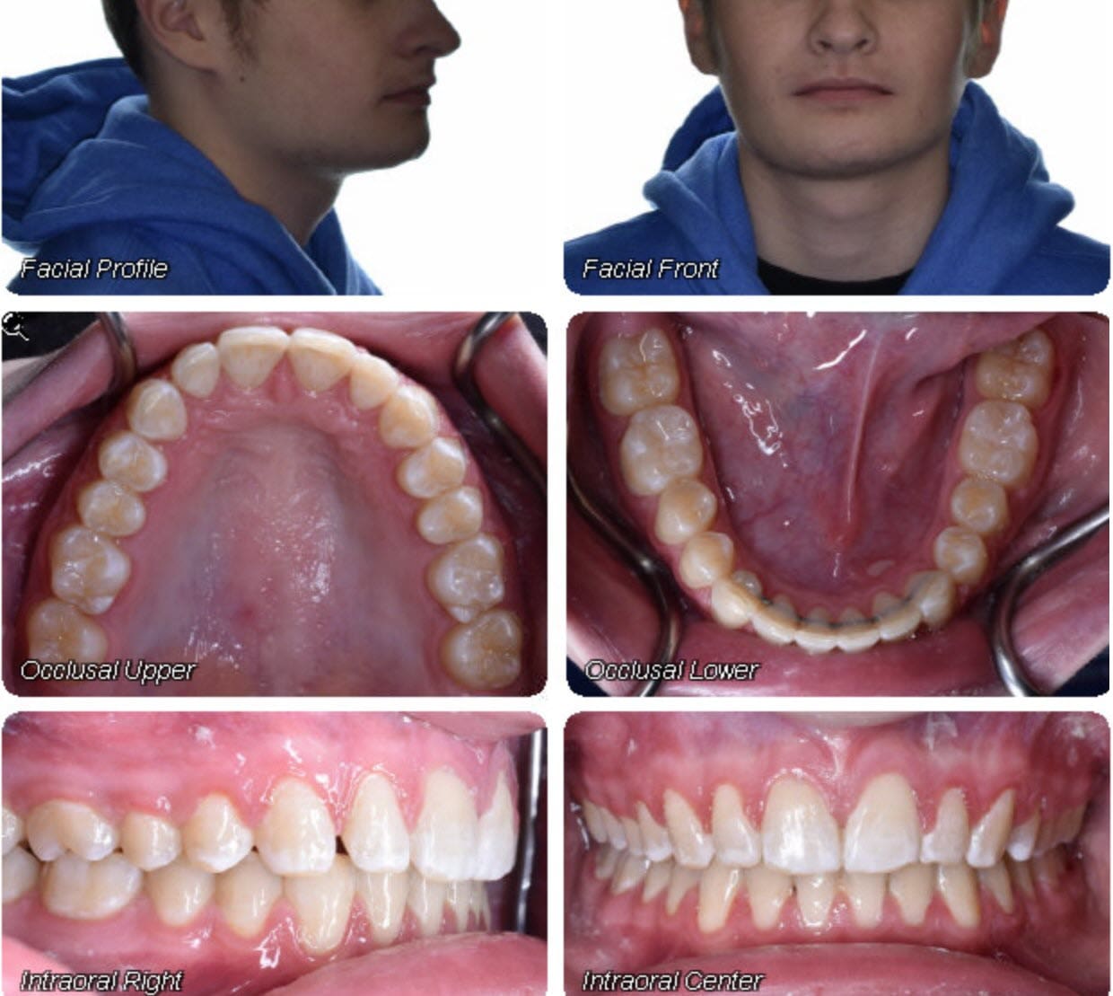 At Wink Orthodontics in Colleyville, TX, four intraoral photos—upper and lower occlusal, right side view, and center front view—are ideal for tracking your teeth’s progress before and after braces.