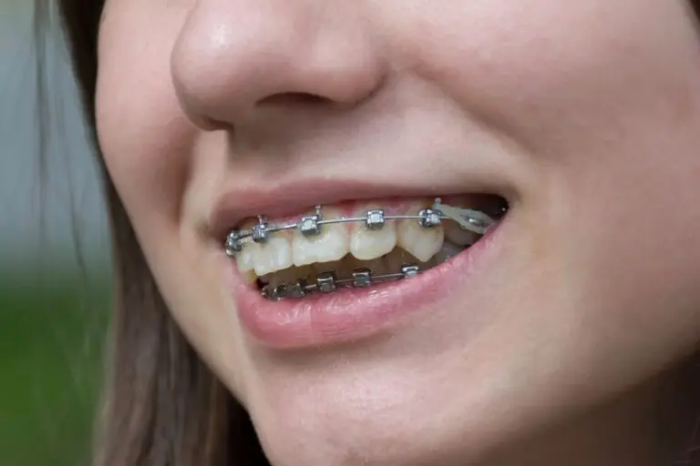 Close-up of a smiling patient showing metal braces on teeth – braces for overbite in prosper and colleyville, tx.
