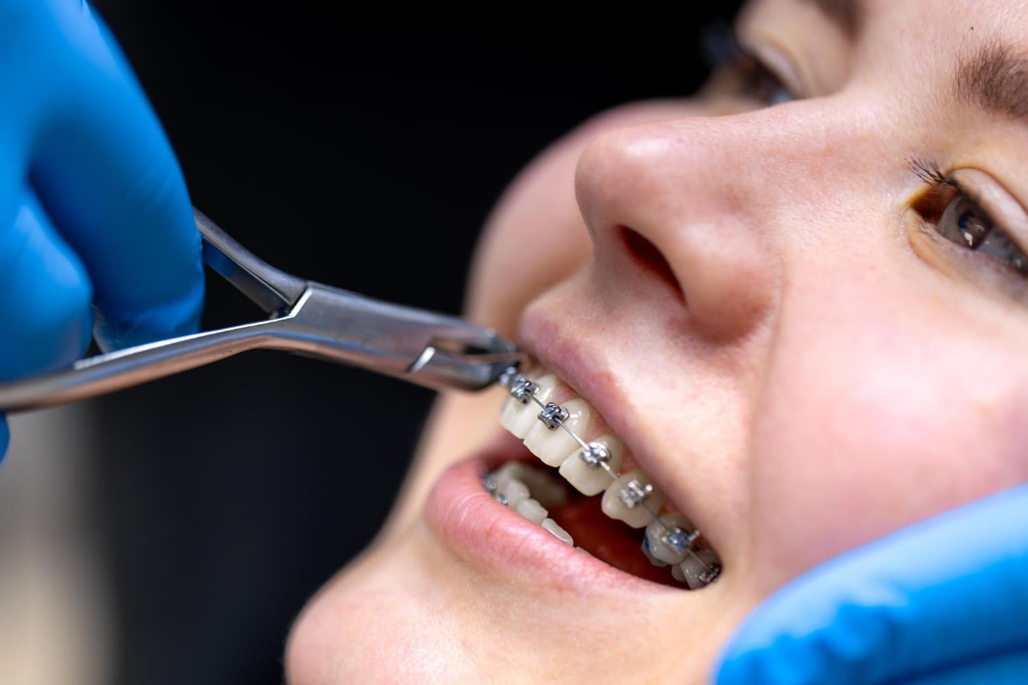 A gloved dentist uses dental pliers to check braces for overbite correction at Wink Orthodontics in Prosper or Colleyville, TX.