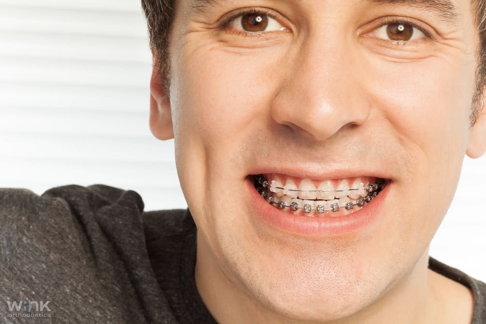 happy young man with metal braces - Overbite vs Underbite in Prosper and Colleyville, TX