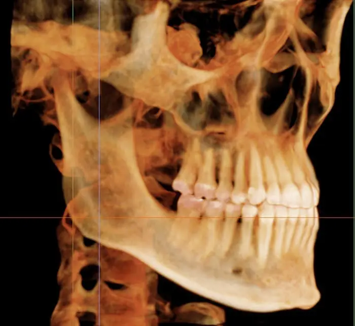 Dr. Mohammed Al-Zainal and Dr. Mo Idilbi: Orthodontist in Colleyville TX Side profile 3D X-ray of a skull and jaw showing teeth and bone at Wink Orthodontics in Colleyville, TX.