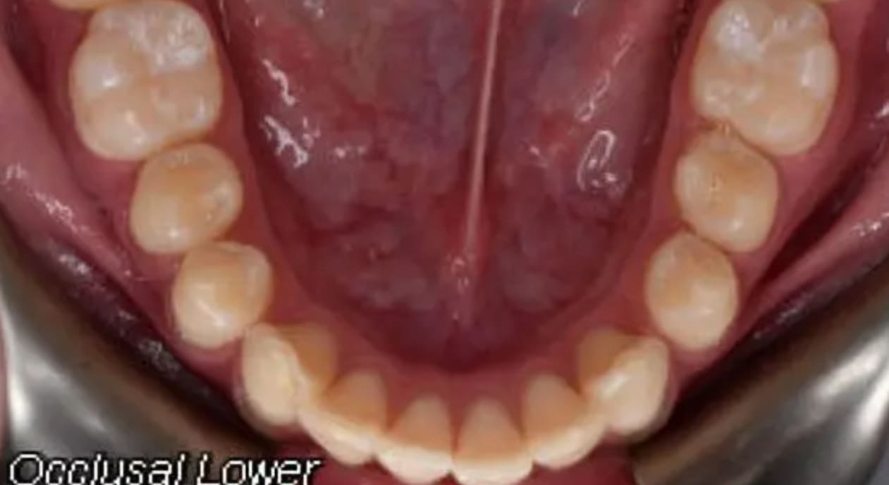 Lower teeth and gums shown from above, displaying dental arches and alignment before braces at Wink Orthodontics in Colleyville, TX.