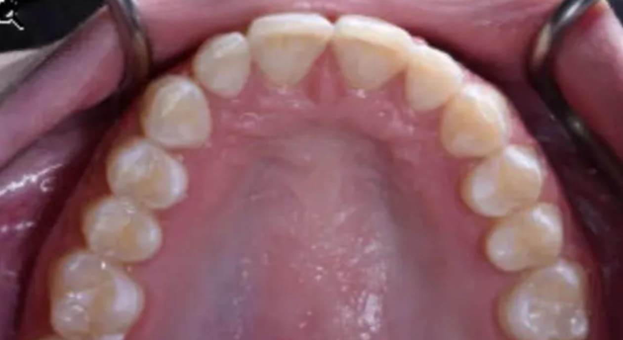 Clean and aligned upper teeth after braces, shown in a mouth close-up at Wink Orthodontics in Colleyville, TX.