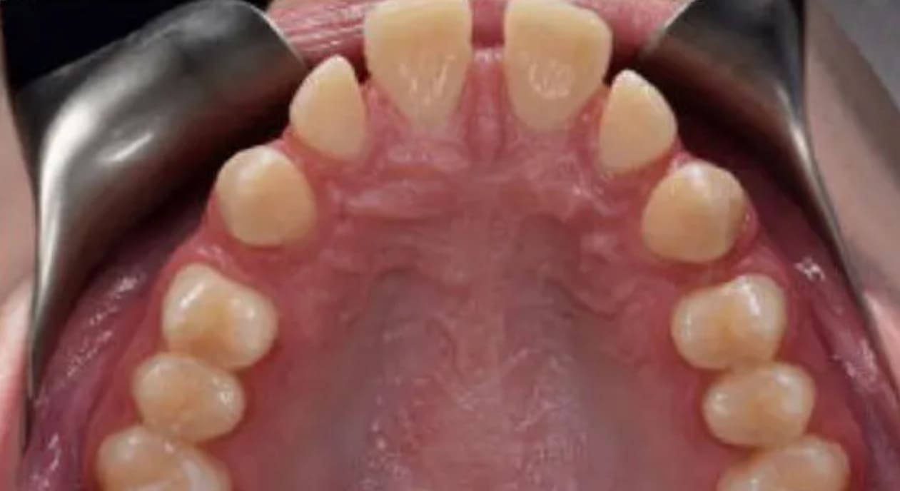 Upper jaw with teeth and gums visible, mouth held open by retractor at Wink Orthodontics in Colleyville, TX.