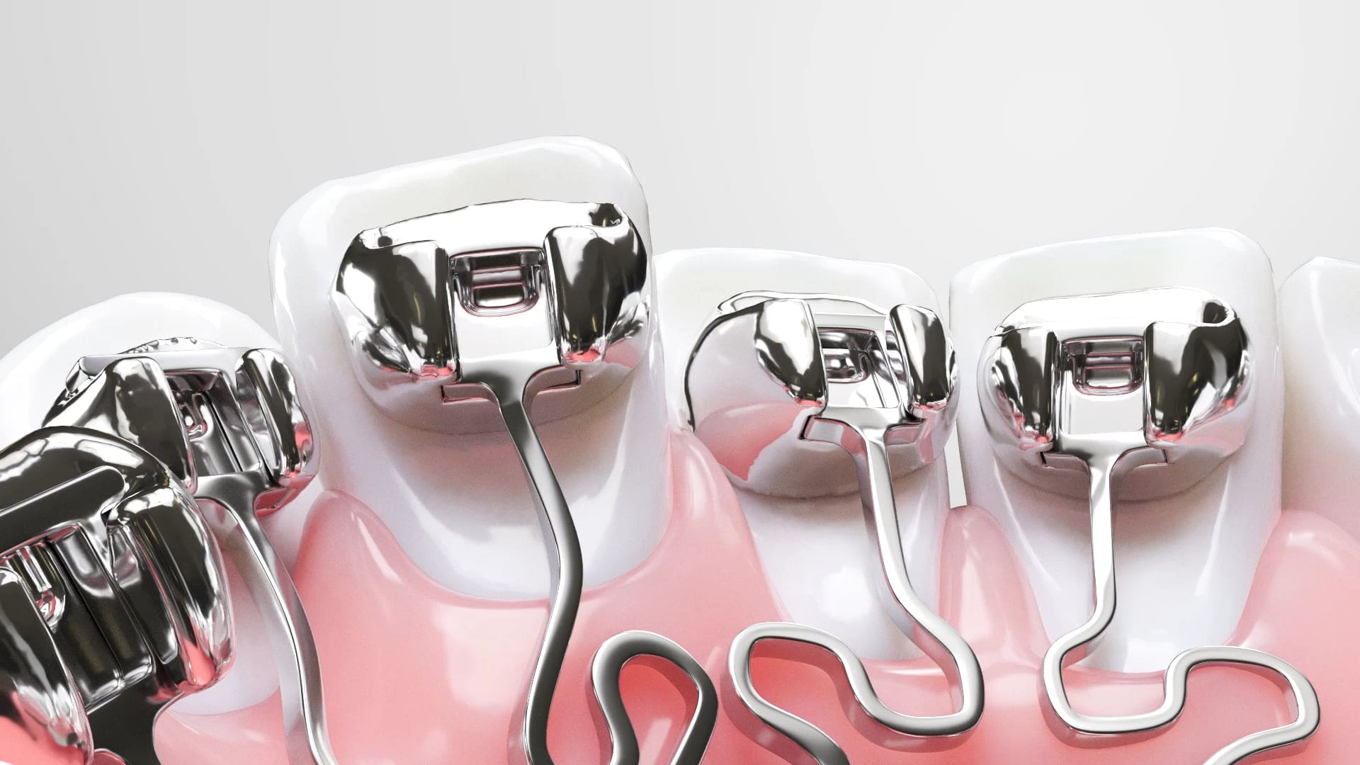 Teeth with metal braces and archwire, showing Brava Independent Movers at Wink Orthodontics in Prosper or Colleyville, TX.