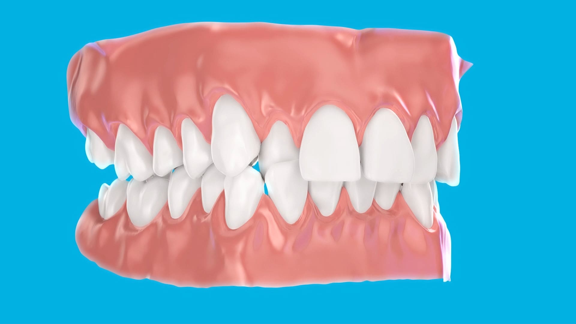Side view 3D render of teeth and gums with Hidden Brava Braces at Wink Orthodontics in Prosper or Colleyville, TX on blue background.