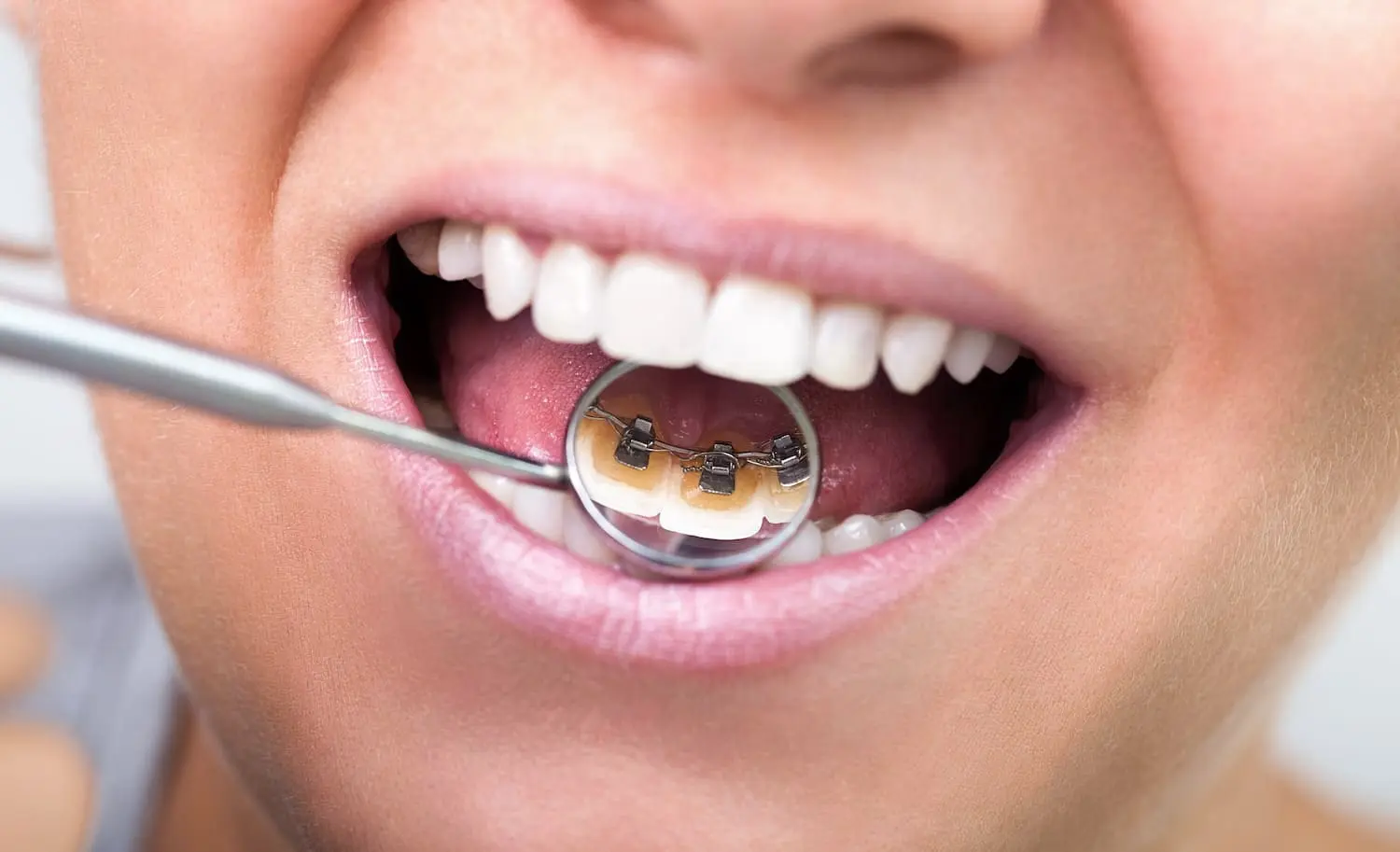 lingual braces illustration from an orthodontist in Colleyville, TX