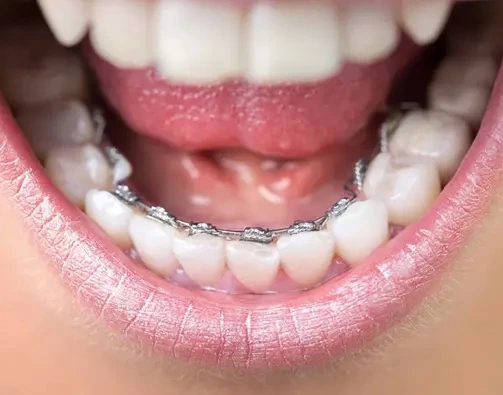 illustration of lingual braces from an Orthodontist in Prosper, TX